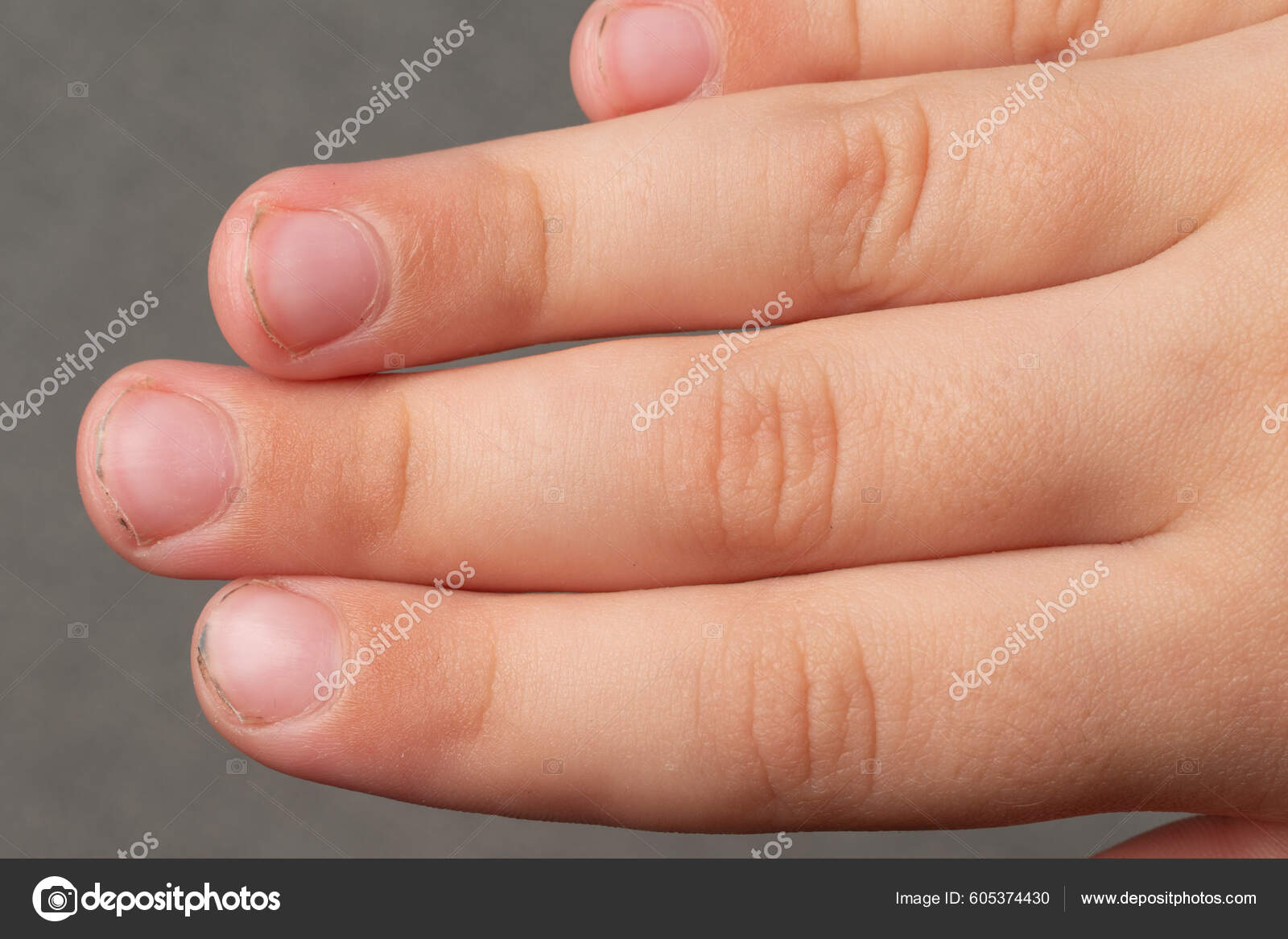 Dirty Sloppily Trimmed Child's Fingernails Fingers Toenails Close