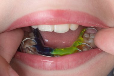 Mandibular plate, boy wearing teeth aligner, teeth and plate in detail.