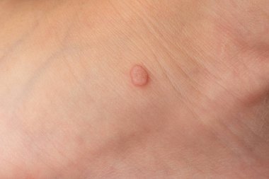 Common wart Verruca vulgaris on the skin of a child, papillomavirus in the body.