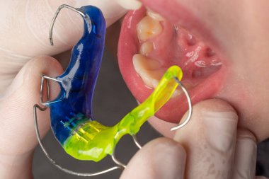Plate for lower teeth, orthodontist and plate for teeth of the lower jaw, child and plate.