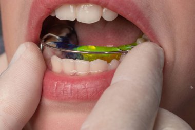 The orthodontist puts a plate on the lower teeth, a visit to the orthodontist, alignment of the child's teeth.