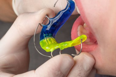 Plate for lower teeth, orthodontist and plate for teeth of the lower jaw, child and plate.