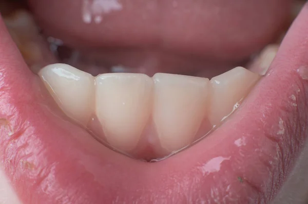 Jaw with children's straight teeth close-up, permanent front teeth of the lower jaw.