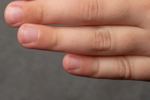 Dirty Sloppily Trimmed Child Fingernails Fingers Toenails Close Little Child — Foto Stock