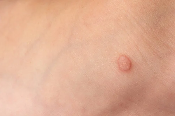 Common Wart Verruca Vulgaris Skin Child Papillomavirus Body — Photo