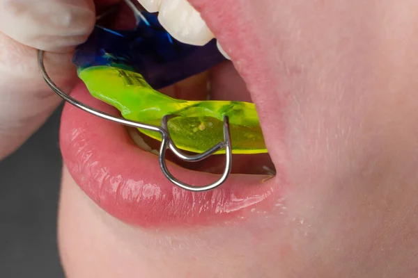 Plate Lower Teeth Orthodontist Plate Teeth Lower Jaw Child Plate — Stok fotoğraf