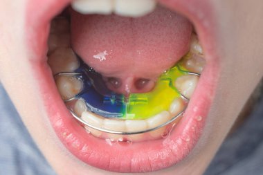 The boy wears a dental plate on the lower jaw, aligning children's teeth.