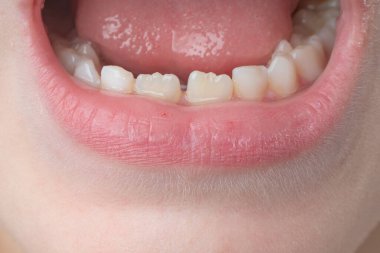 Jaw with child's even teeth close-up, milk and permanent teeth in a child.