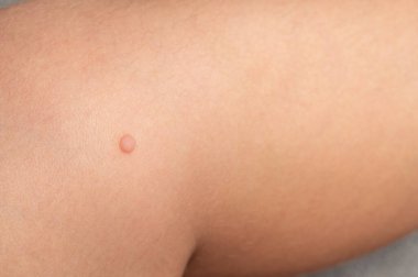 Common wart Verruca vulgaris on the skin of a child, papillomavirus in the body.