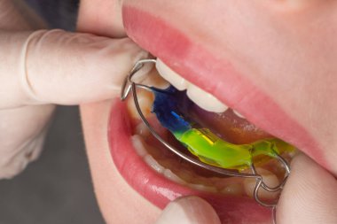 The orthodontist puts a plate on the lower teeth, a visit to the orthodontist, alignment of the child's teeth.