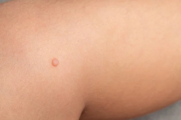 Common Wart Verruca Vulgaris Skin Child Papillomavirus Body — Stockfoto
