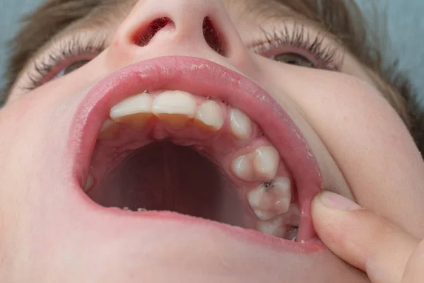 Jaw with children\'s straight teeth close-up, caries on deciduous and permanent teeth.