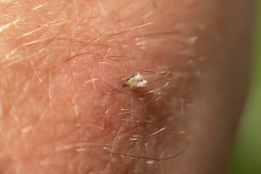 Swollen bee sting site, redness of the skin from a bee sting, close-up of a bee sting.