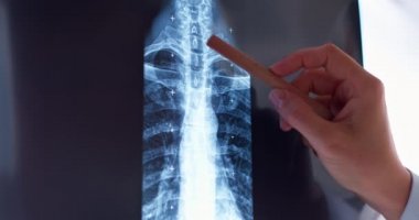 Doktor X-ray üzerinde kemikler çıkardı.