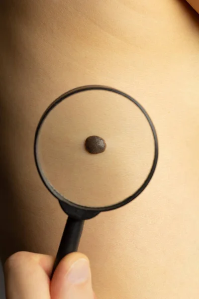 Dermatólogo Examina Lunar Paciente Con Una Lupa — Foto de Stock