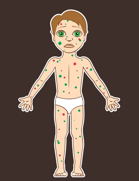 Petit garçon a la varicelle — Image vectorielle