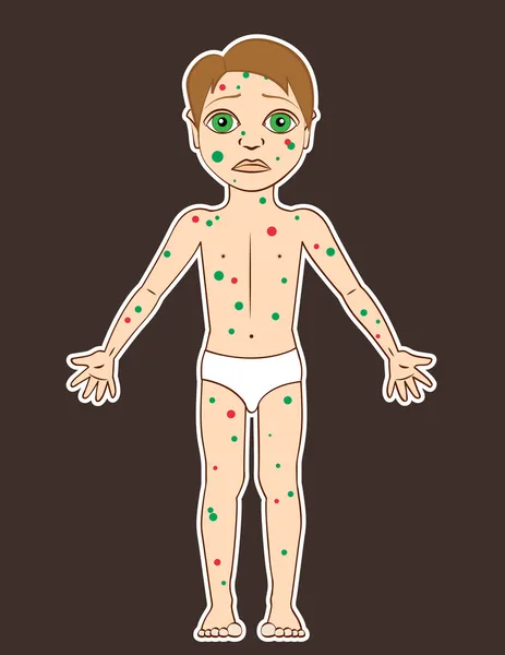 Kleiner Junge mit roten und grünen Flecken hat Windpocken — Stockillustration Kleiner Junge hat Windpocken — Stockvektor