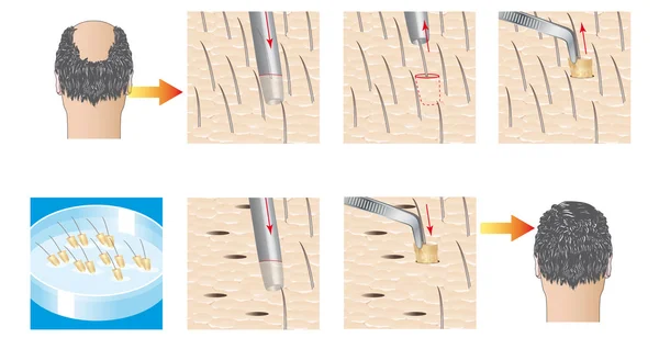 Transplante de cabelo — Vetor de Stock