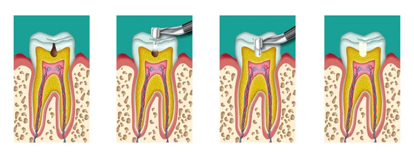 Cariës — Stockvector