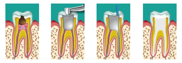 Desvitalización — Vector de stock