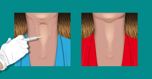 Pescoço botulínico —  Vetores de Stock