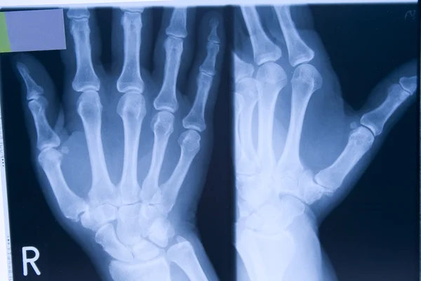 Röntgen bild av en hand — Stockfoto