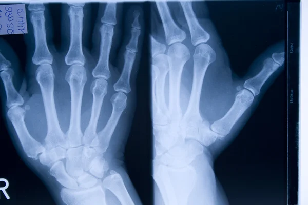 Röntgenbild einer Hand — Stockfoto