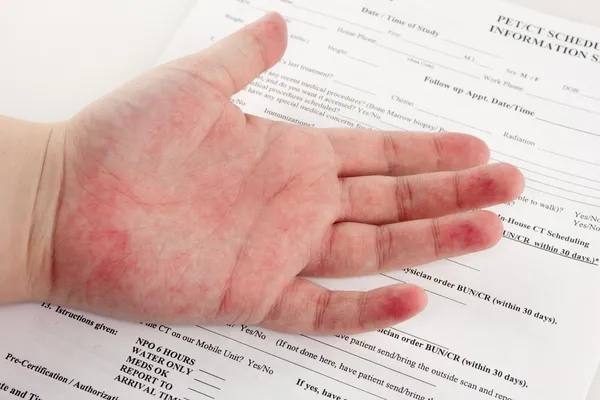 手の赤い発疹 — ストック写真