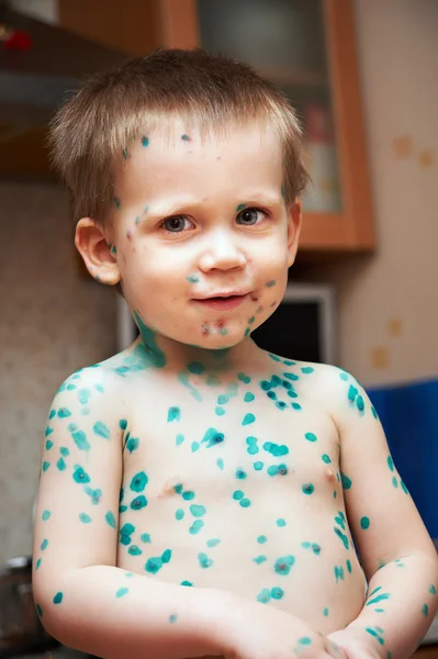 Little boy is sick with chickenpox — Stock Photo, Image