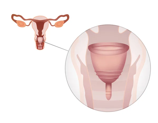 说明如何在经期使用月经杯 白色背景的女性生殖系统 — 图库照片