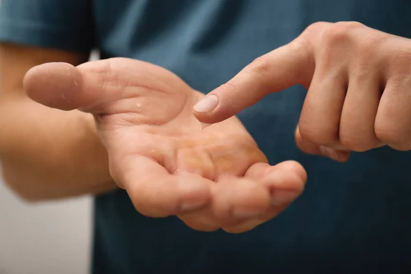 Hombre Aplicando Crema Mano Para Tratamiento Callos Sobre Fondo Gris — Foto de Stock