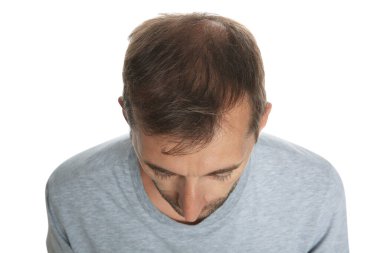 Man with hair loss problem isolated on white, above view clipart