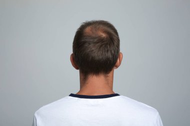 Açık gri arka planda saç kaybı sorunu olan bir adam.