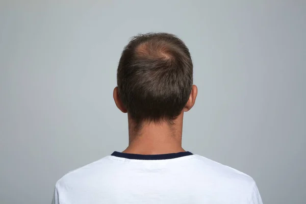 Muž Problémem Vypadávání Vlasů Světle Šedém Pozadí Pohled Zezadu — Stock fotografie
