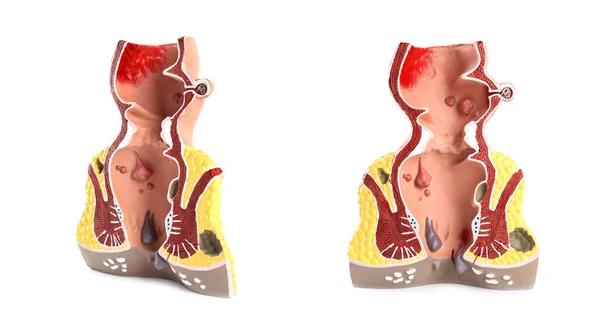 Modelo Anatómico Recto Con Hemorroides Sobre Fondo Blanco Collage —  Fotos de Stock