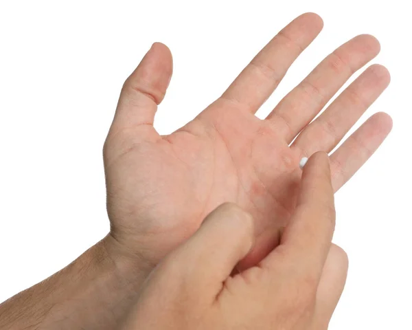 Mężczyzna Stosujący Krem Rękę Leczenia Modzeli Białym Tle Zbliżenie — Zdjęcie stockowe
