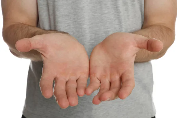 Hombre Que Sufre Callos Las Manos Contra Fondo Blanco Primer — Foto de Stock