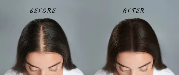 Жінка Проблемою Випадіння Волосся Після Лікування Сірому Фоні Колаж Відвідування — стокове фото