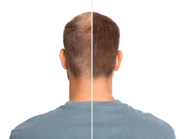 前と白の背景に治療後の脱毛の問題を持つ男 コラージュ 三学者を訪ねる — ストック写真