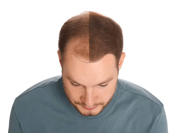 Людина Проблемою Випадіння Волосся Після Лікування Білому Тлі Колаж Відвідування — стокове фото