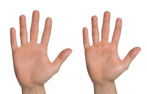 Homem Mostrando Mãos Sem Com Calos Fundo Branco Close Colagem — Fotografia de Stock