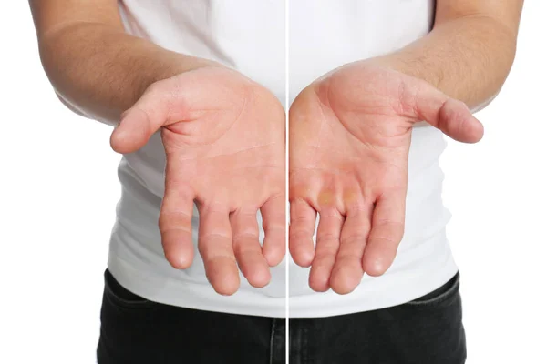 Homem Mostrando Mãos Sem Com Calos Fundo Branco Close Colagem — Fotografia de Stock