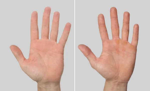 Άνθρωπος Δείχνει Χέρια Χωρίς Και Κάλους Ανοιχτό Γκρι Φόντο Closeup — Φωτογραφία Αρχείου
