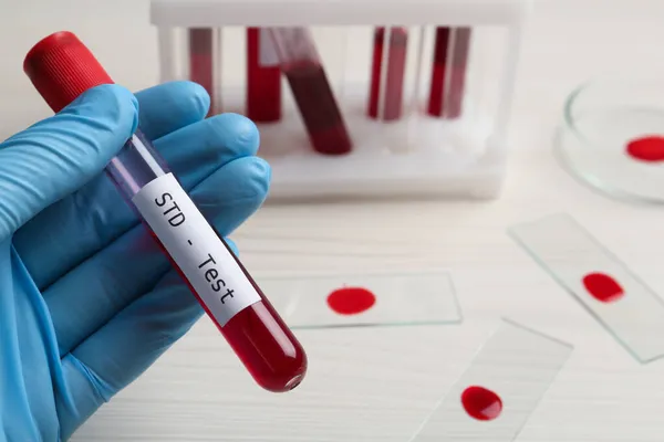 Tudósok Vérmintával Ellátott Csövet Tartanak Std Tesztet Végeznek Fehér Asztalnál — Stock Fotó
