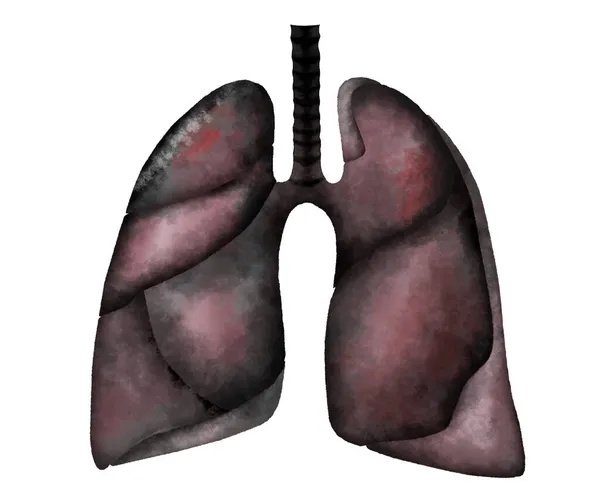 Ilustración Los Pulmones Humanos Afectados Por Enfermedad Fondo Blanco — Foto de Stock