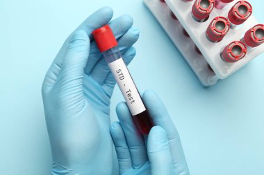 Bilim adamı, üzerinde kan örneği olan tüp tutuyor ve açık mavi arka plan üzerinde STD testi yapıyor.