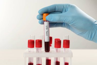 Bilim adamı kan örneğiyle tüp alıyor ve beyaz masadaki raflardan STD testi yapıyor.