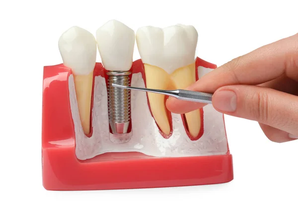 Mulher Apontando Para Implante Dentário Entre Dentes Modelo Educacional Sobre — Fotografia de Stock