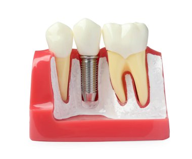 Beyaz arka planda diş implantı olan eğitim amaçlı bir sakız modeli.