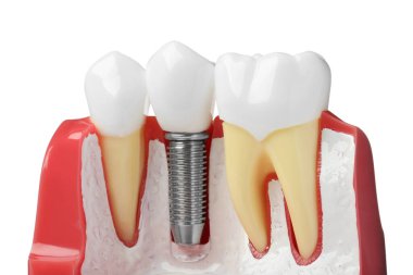Beyaz arka planda diş implantı olan eğitim amaçlı bir sakız modeli.